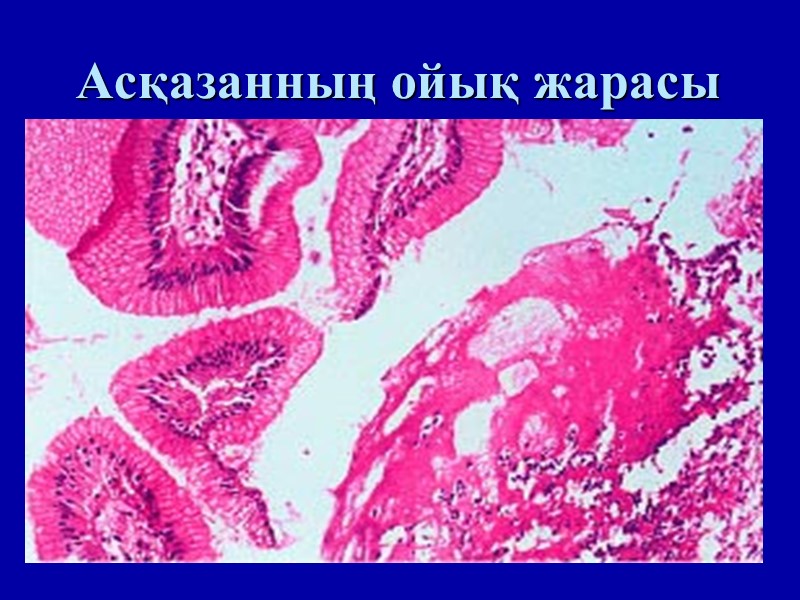 Асқазанның ойық жарасы